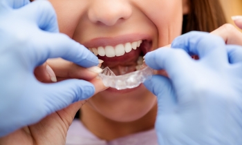 Apparecchio invisibile: tutti i consigli per gestire al meglio il trattamento con le mascherine ortodontiche trasparenti per riallineare i denti